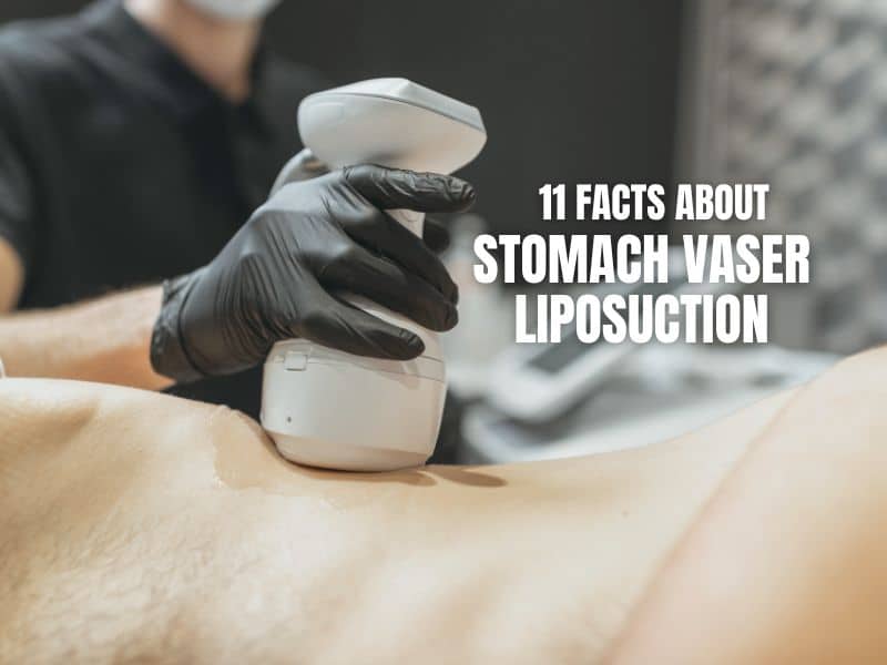 11 Facts About Stomach VASER Liposuction