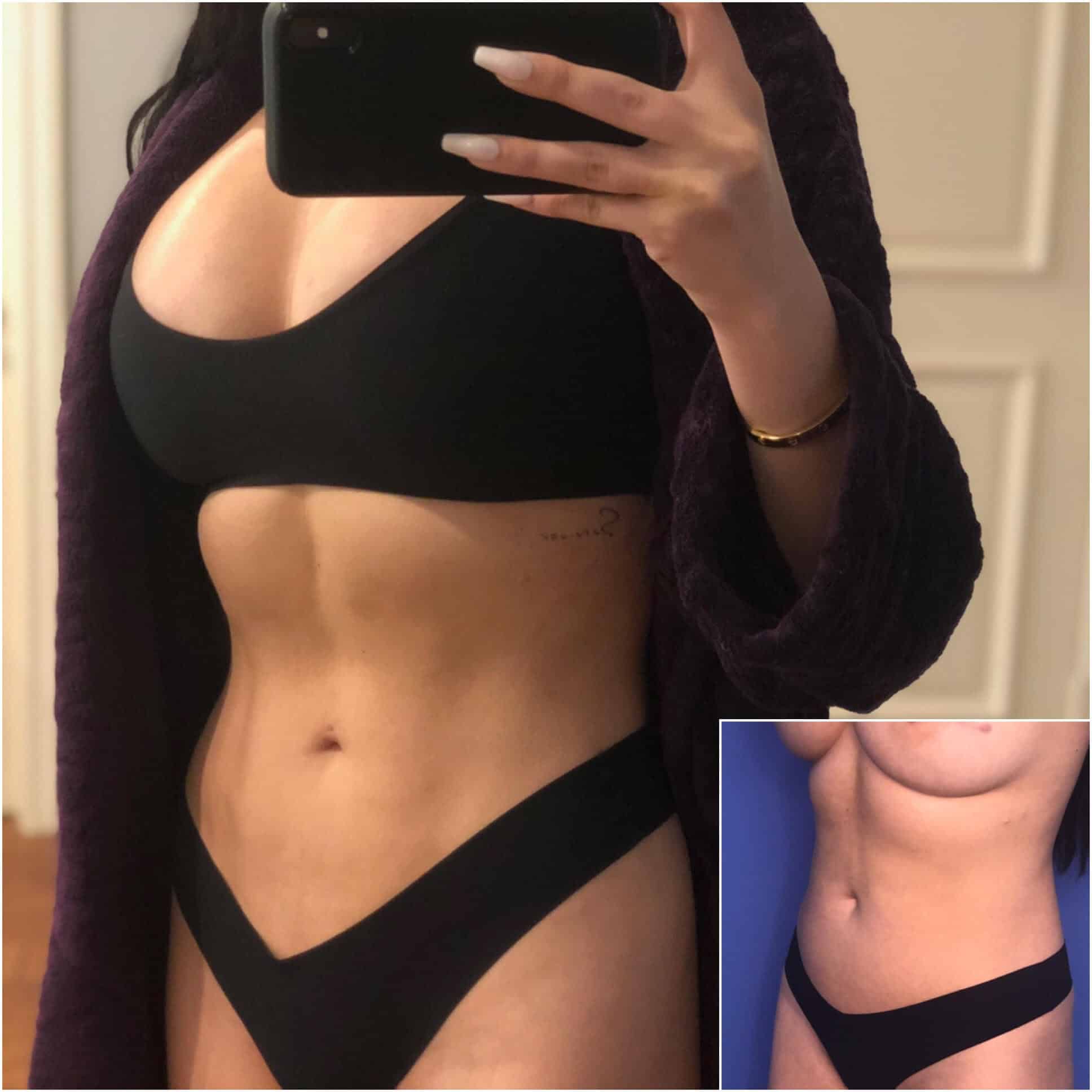 HD Lipo Before and After