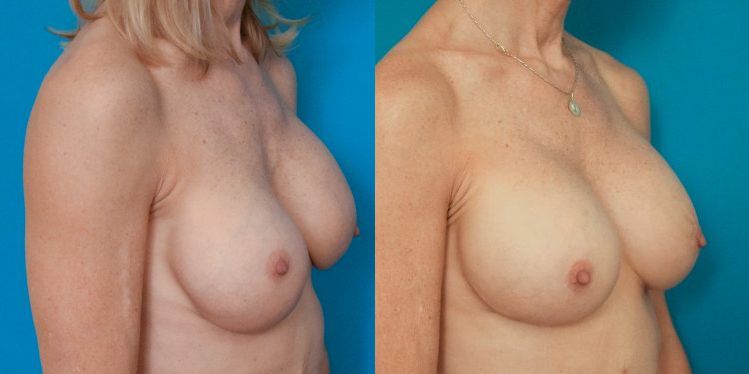 breast_revision_01_2