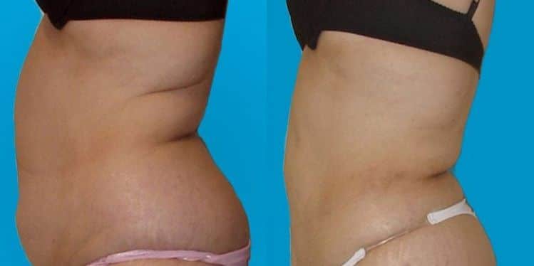 Non Invasive liposuction