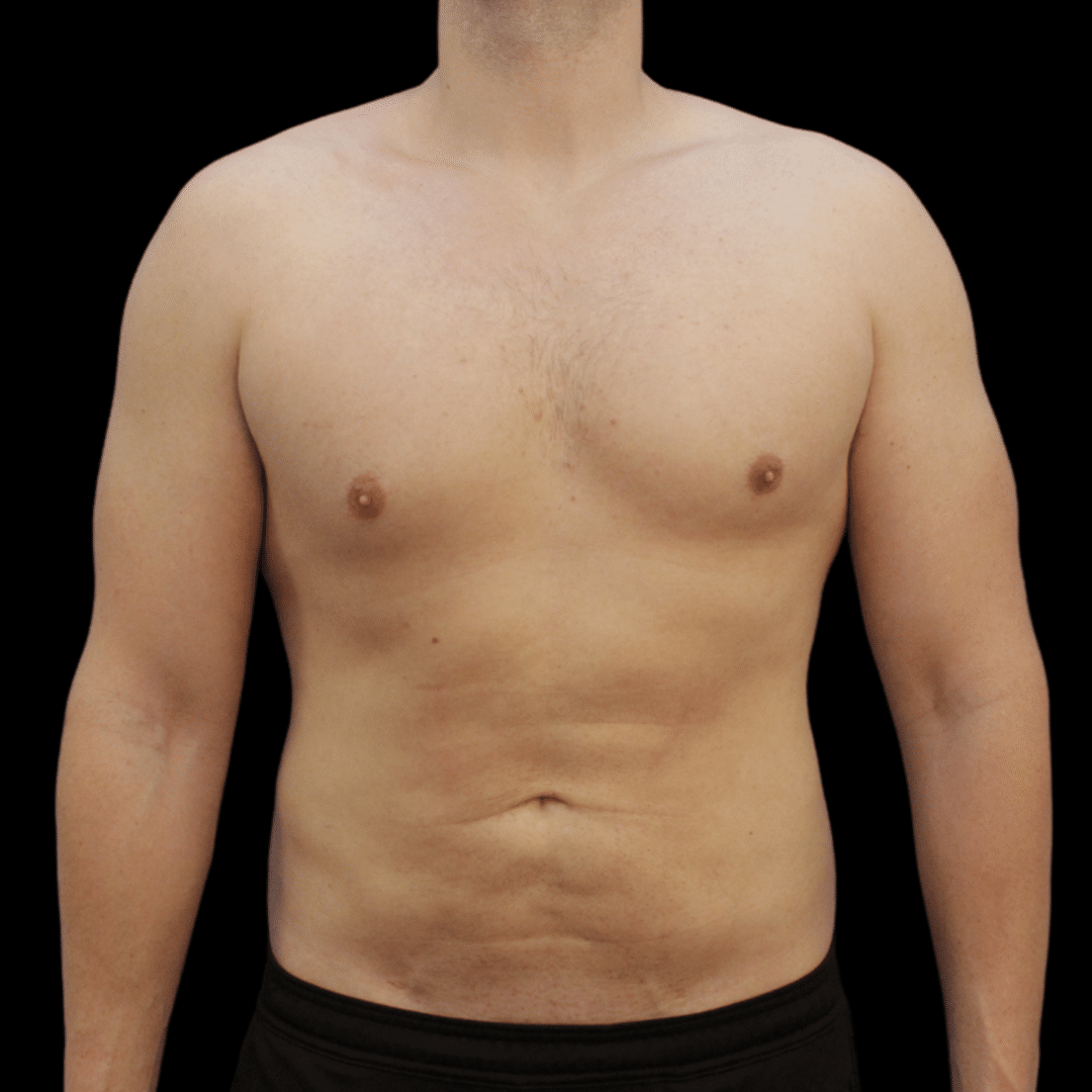 Body-Procedures/High Definition Liposuction
