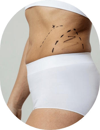 Liposuction Galanis Beverly Hills