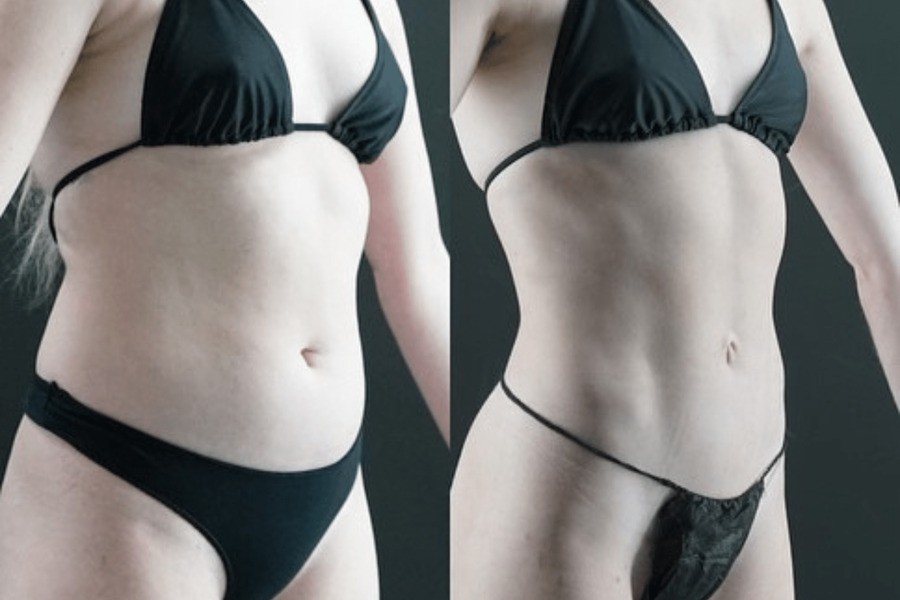 VASER High Definition Liposuction PC