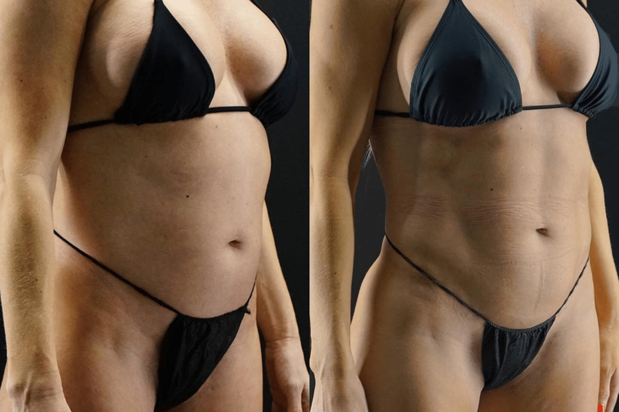 VASER High Definition Liposuction PD