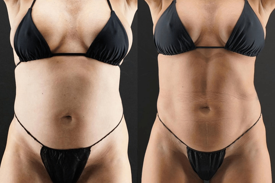 VASER High Definition Liposuction PE