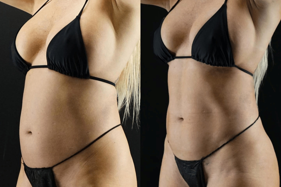 VASER High Definition Liposuction PF