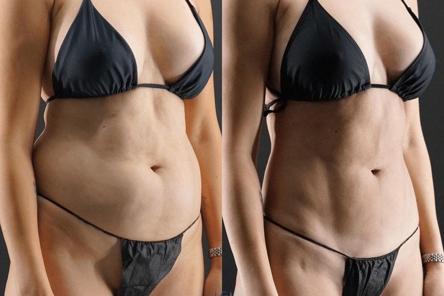 VASER High Definition Liposuction PG Front