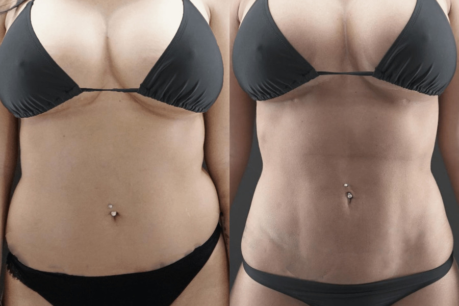 VASER-High-Definition-Liposuction PH Front