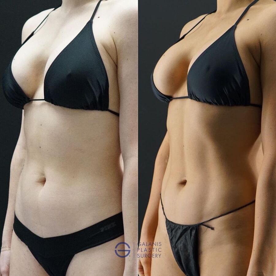 VASER-High-Definition-Liposuction PI