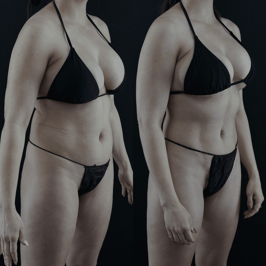 VASER-High-Definition-Liposuction PJ Lateral