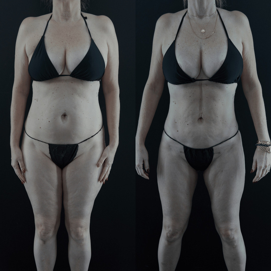 VASER-High-Definition-Liposuction PK Front