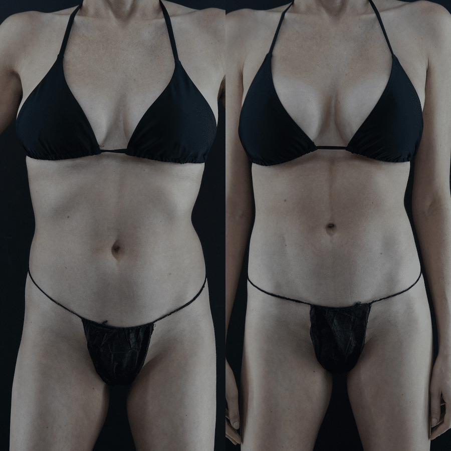 VASER-High-Definition-Liposuction PL Front