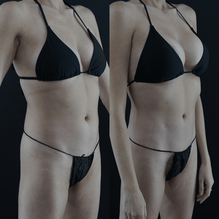 VASER-High-Definition-Liposuction PL Lateral