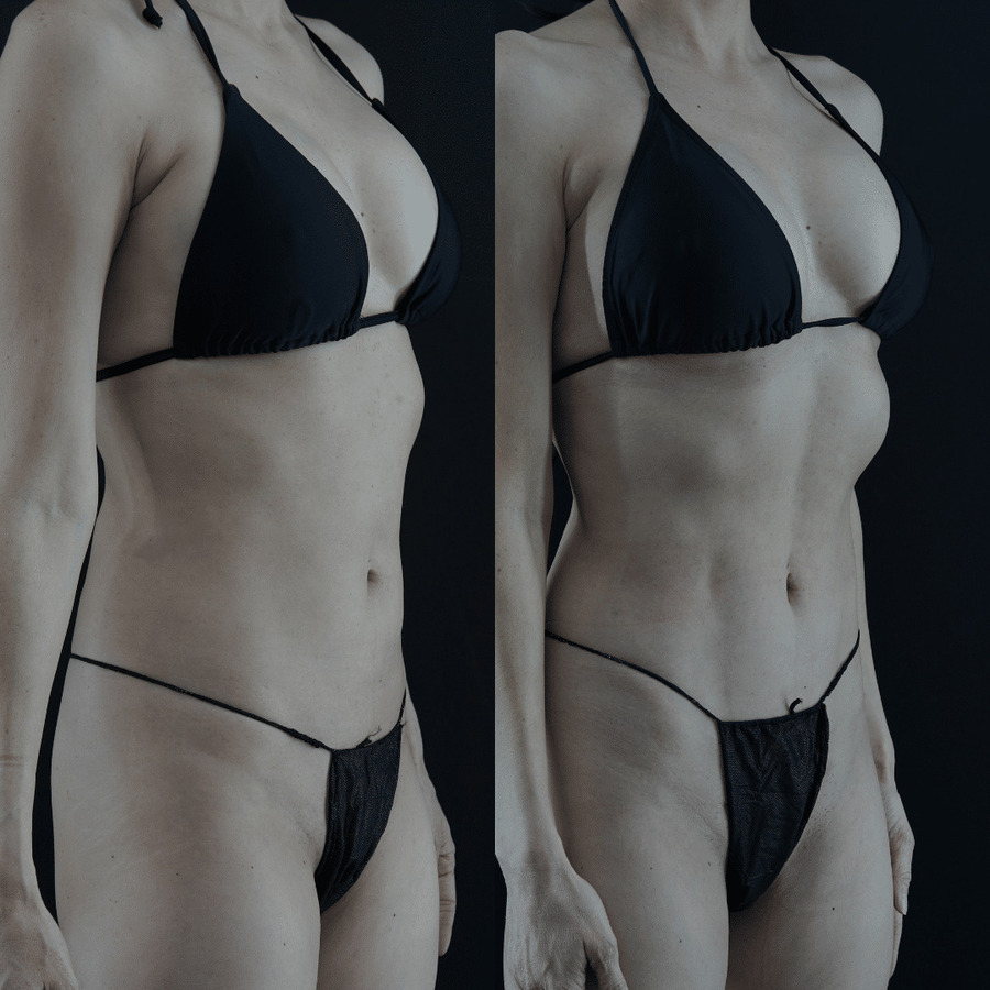 VASER-High-Definition-Liposuction PM Lateral