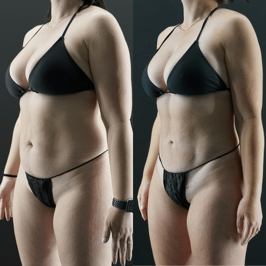 VASER-High-Definition-Liposuction PN Right