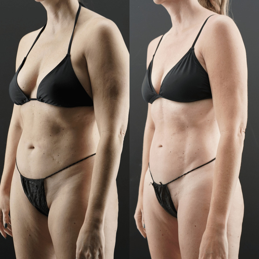 VASER-High-Definition-Liposuction PO Left