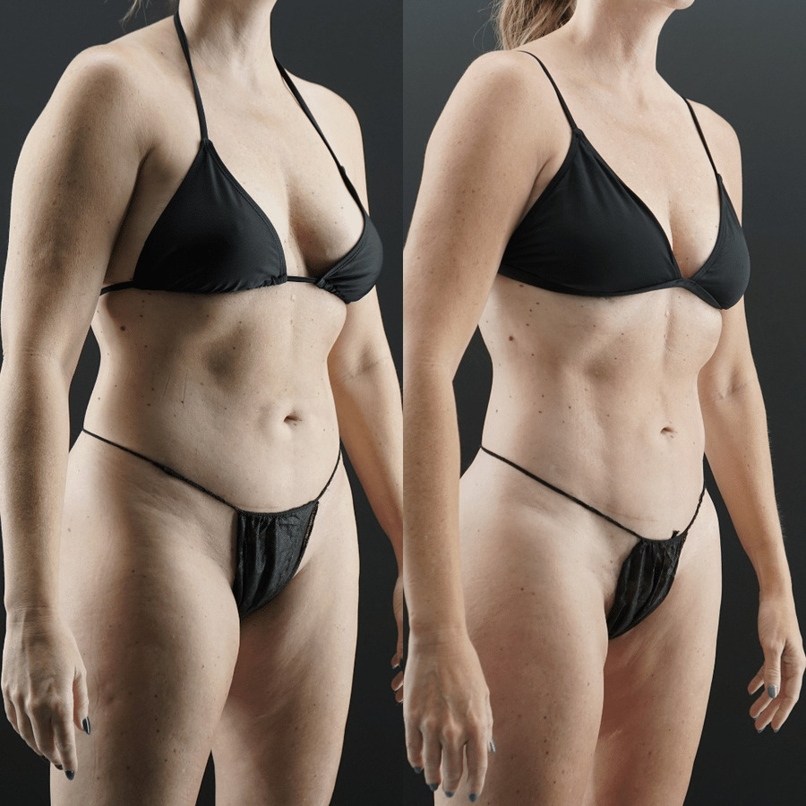 VASER-High-Definition-Liposuction PO Right