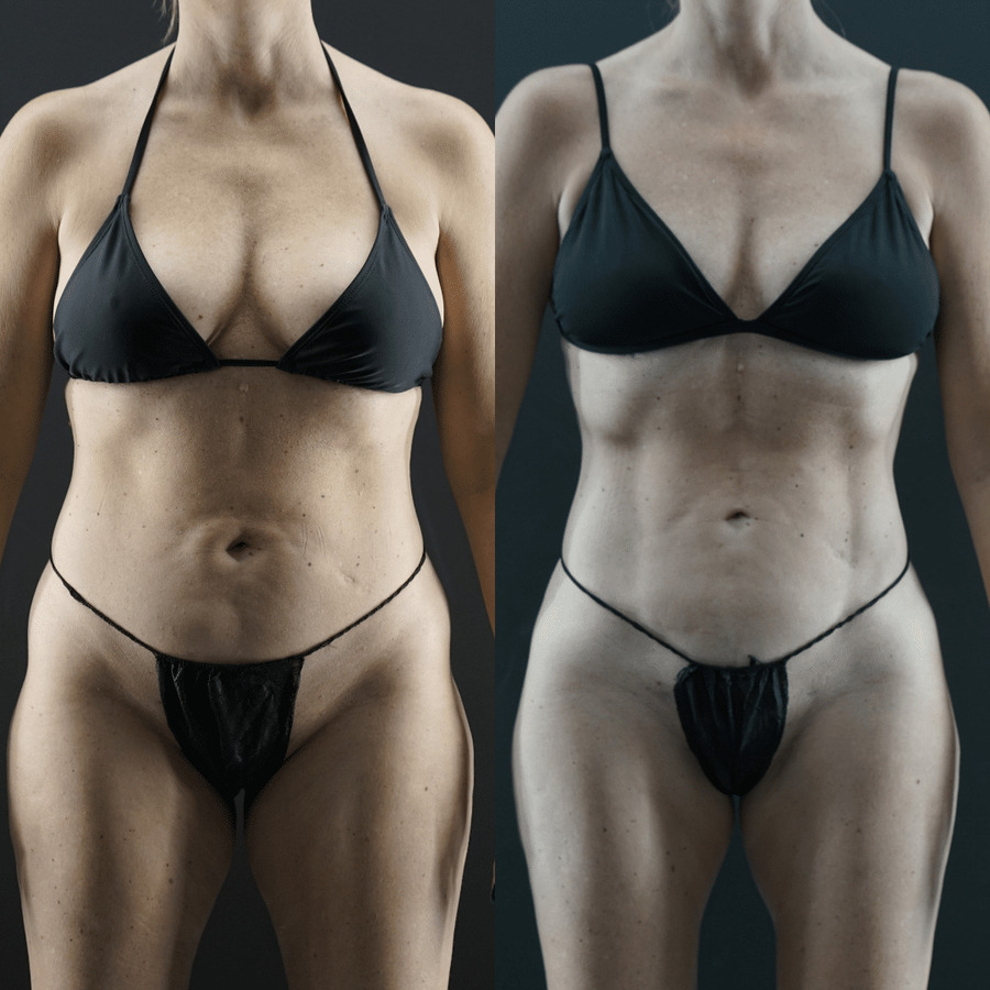 VASER-High-Definition-Liposuction PO front