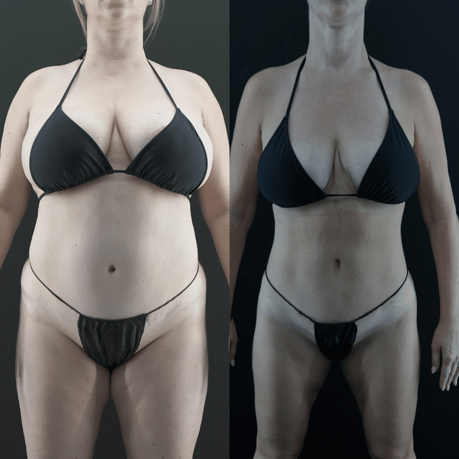 VASER-High-Definition-Liposuction PR Front