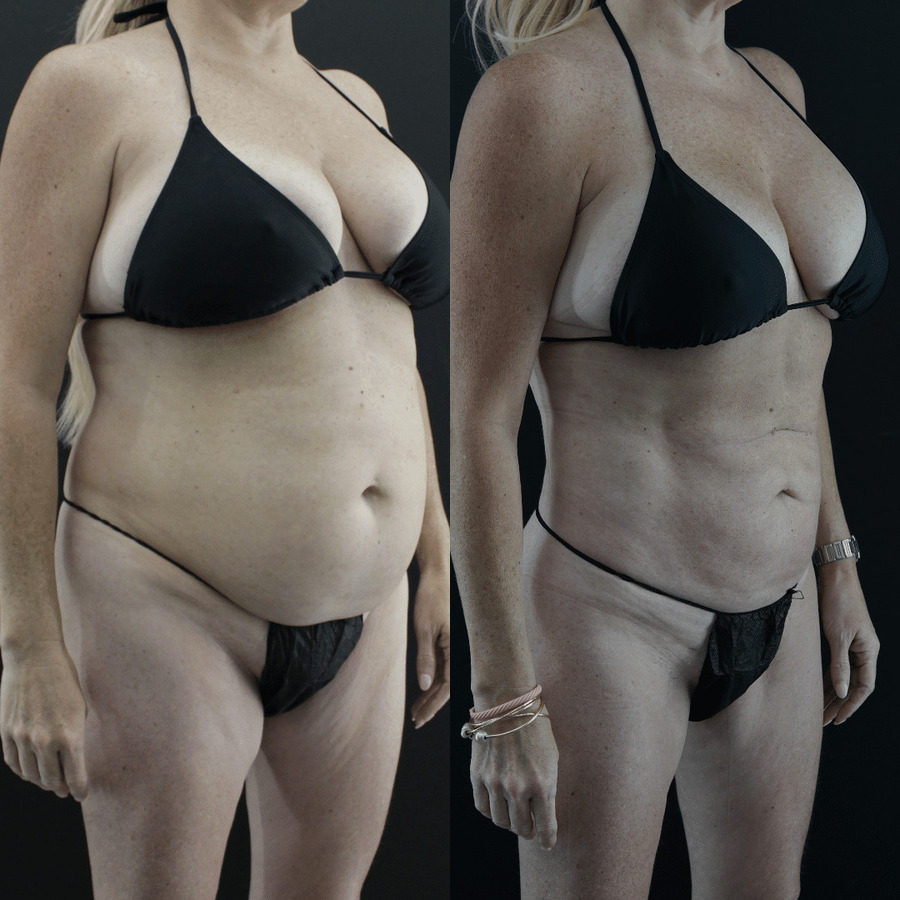 VASER-High-Definition-Liposuction PR Lateral