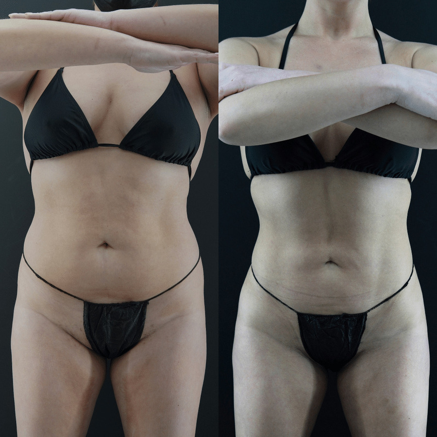 VASER High Definition Liposuction PS Front