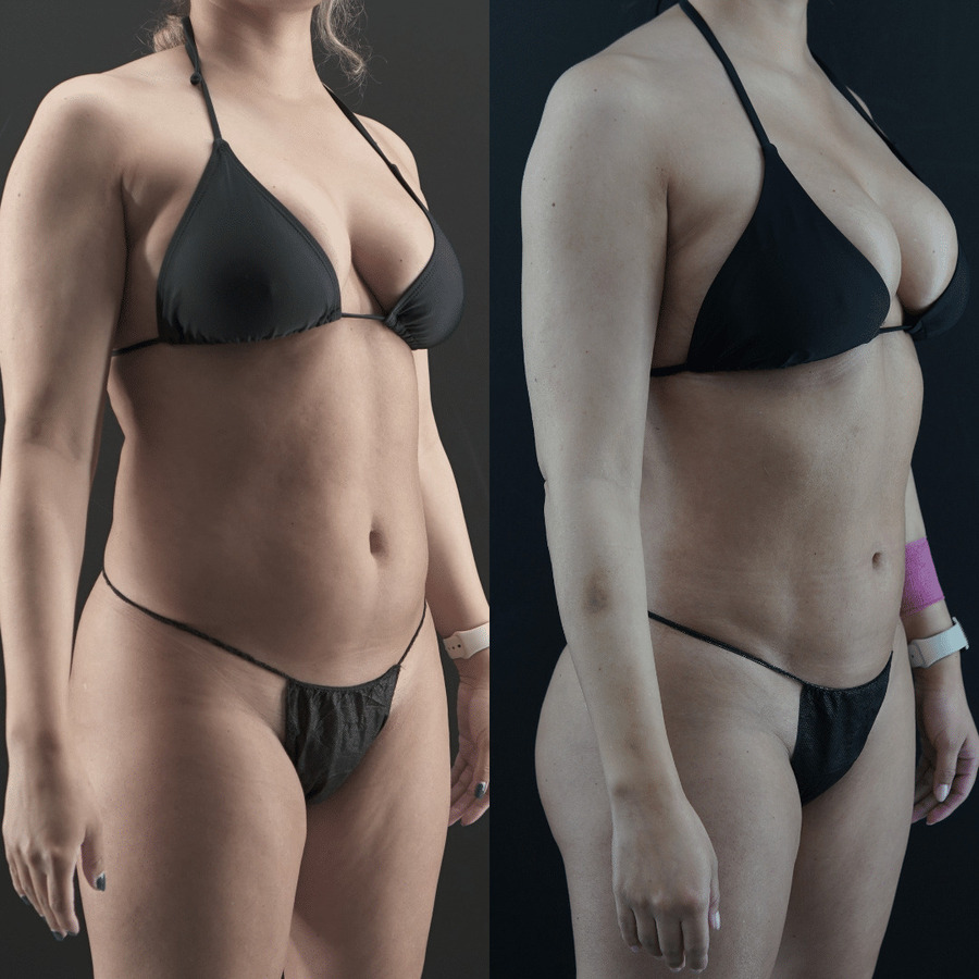 VASER-High-Definition-Liposuction PS Left