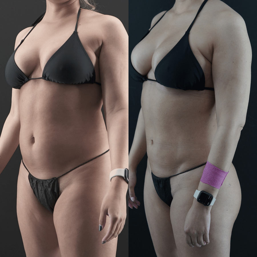 VASER-High-Definition-Liposuction PS Right