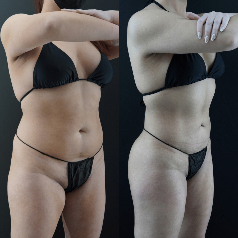 VASER High Definition Liposuction PS lateral