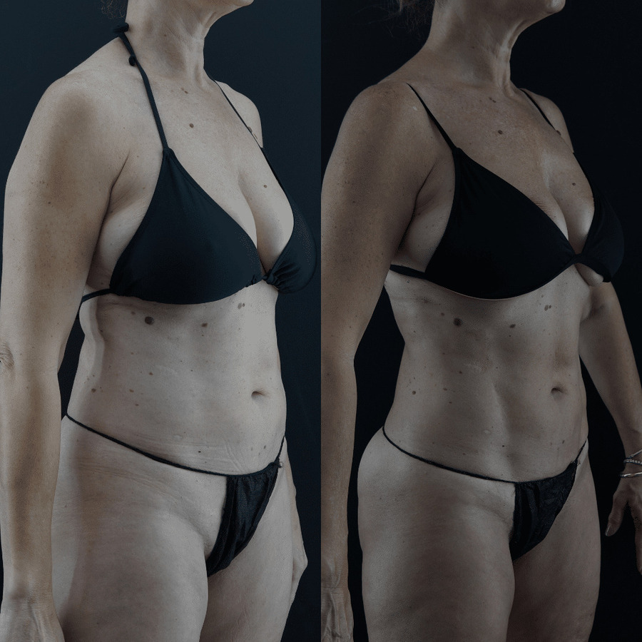 VASER High Definition Liposuction PV Lateral