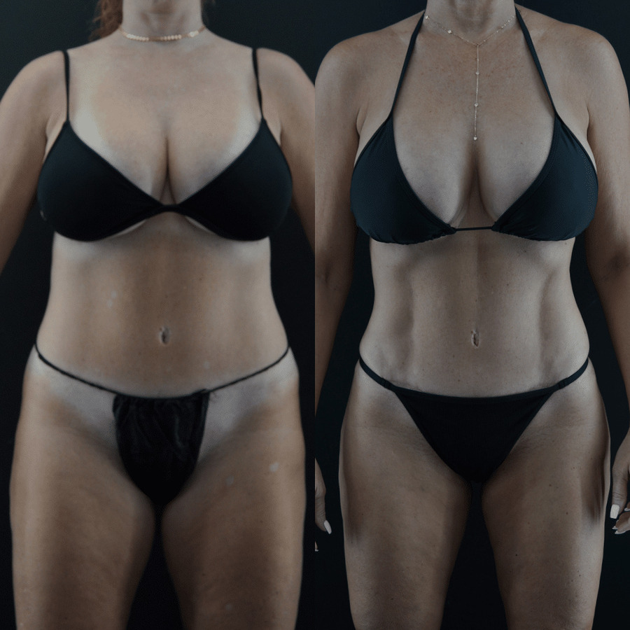 VASER High Definition Liposuction PW Front