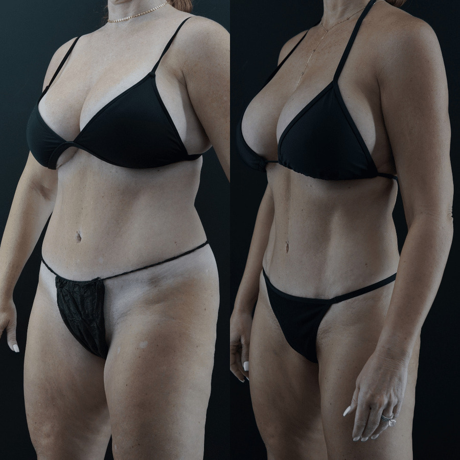 VASER High Definition Liposuction PW lateral