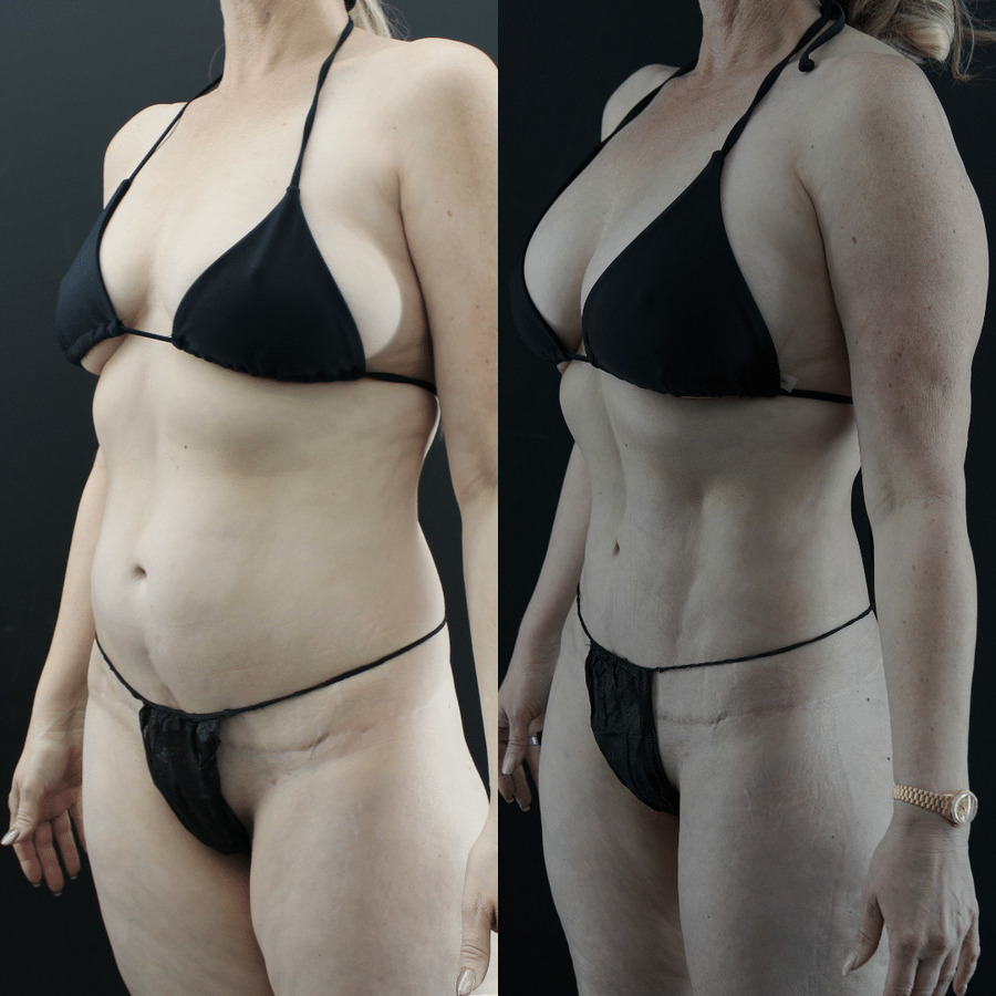 VASER High Definition Liposuction PX Left