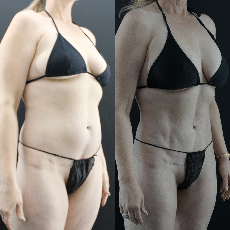 VASER High Definition Liposuction PX Right