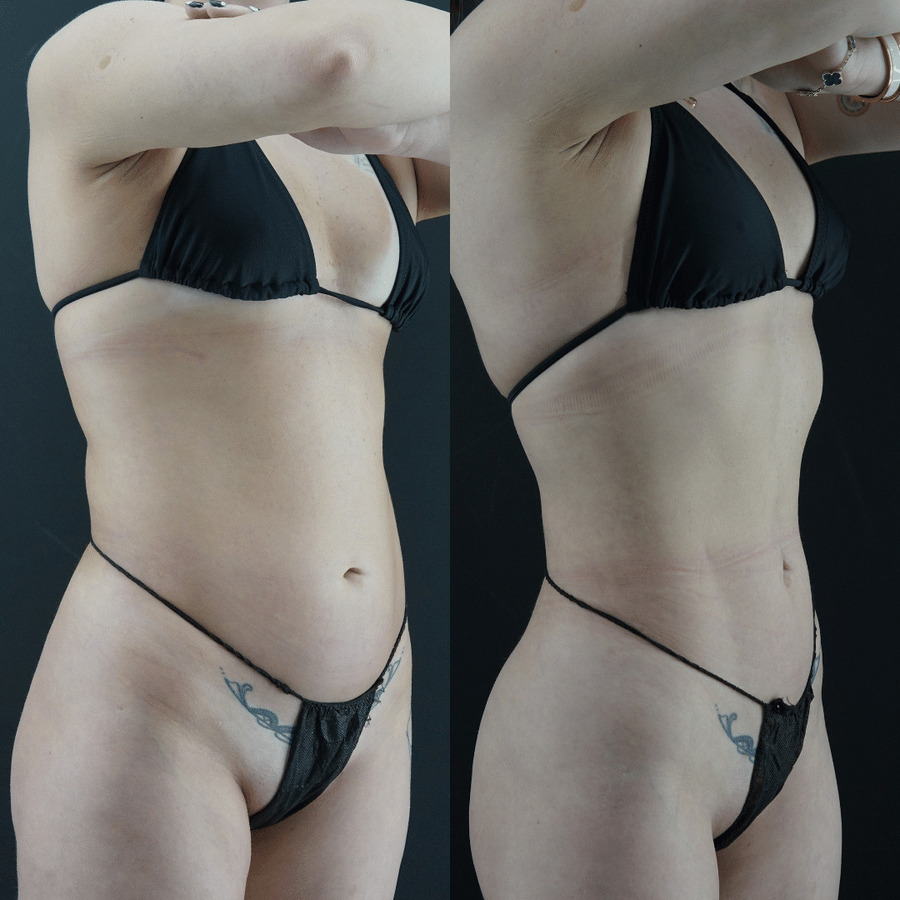 VASER High Definition Liposuction PY Lateral