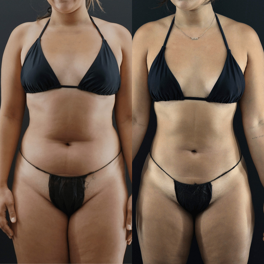 VASER High Definition Liposuction PZ Front