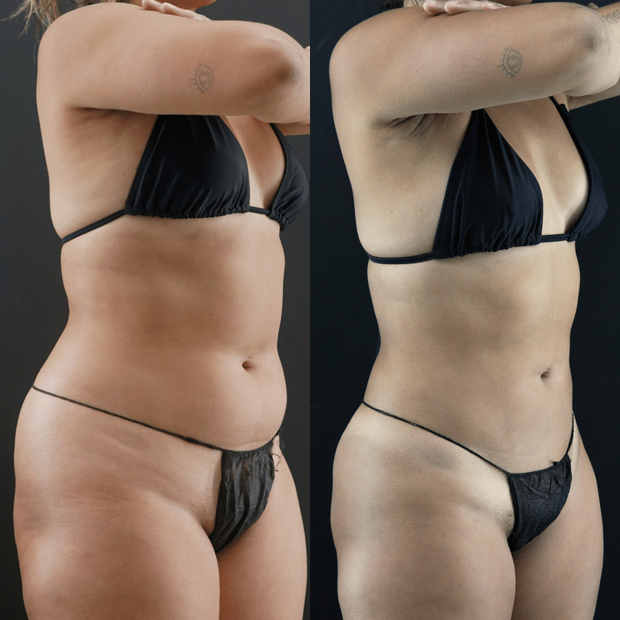 VASER High Definition Liposuction PZ Lateral