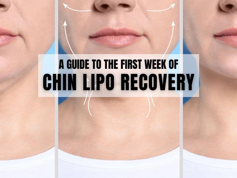 A Guide to the First Week of Chin Lipo Recovery