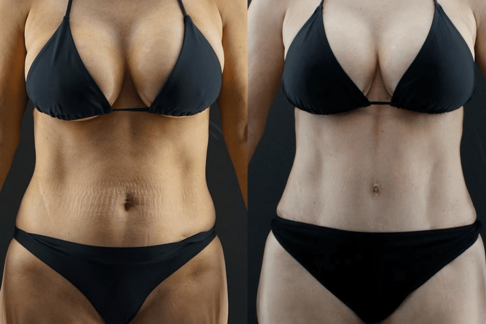 Abdominoplasty Surgery Before and After
