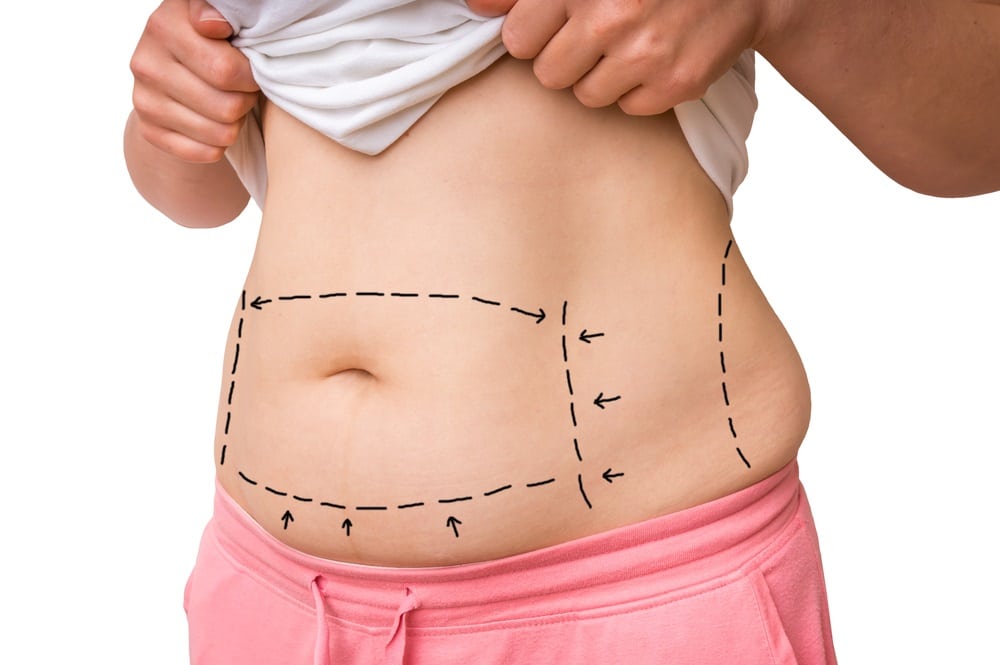 All About Abdominoplasty Surgery