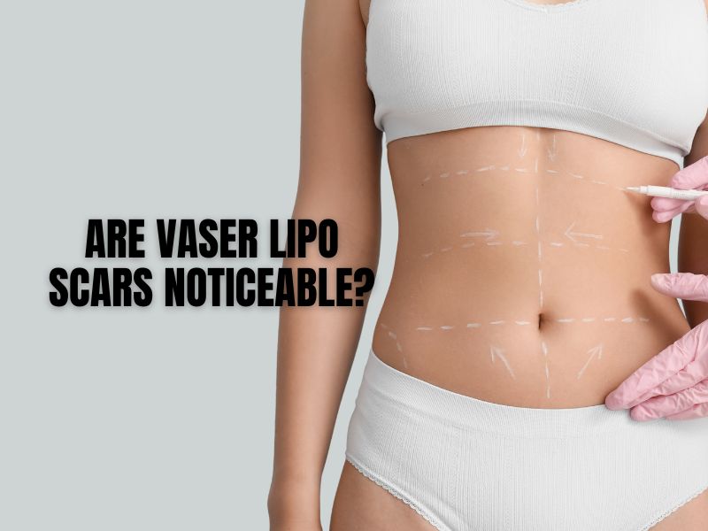 Are VASER Lipo Scars Noticeable