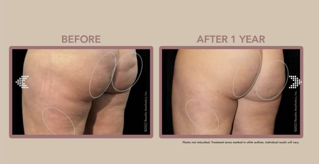 Aveli Cellulite Reduction after 1 year