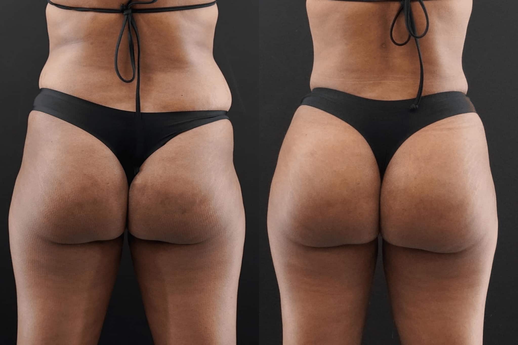 Brazilian Butt Lift Beverly Hills, BBL Surgery