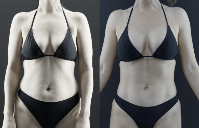 Before and After Beverly Hills Mini Tummy Tuck