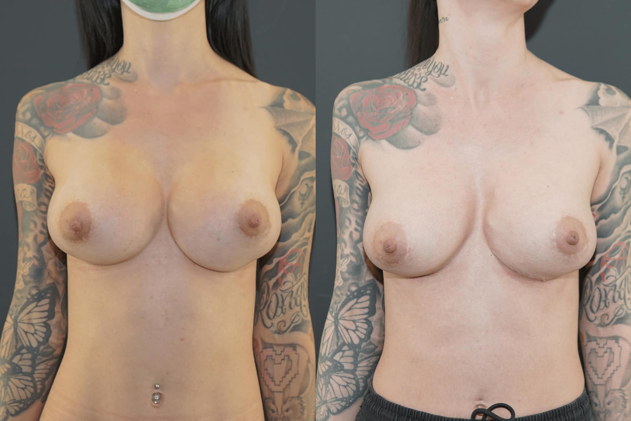 Before and After Breast Implant Revision Beverly Hills
