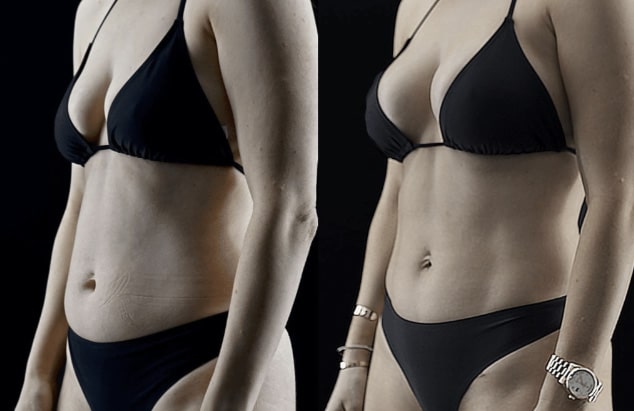 Before and After Mini Tummy Tuck Beverly Hills