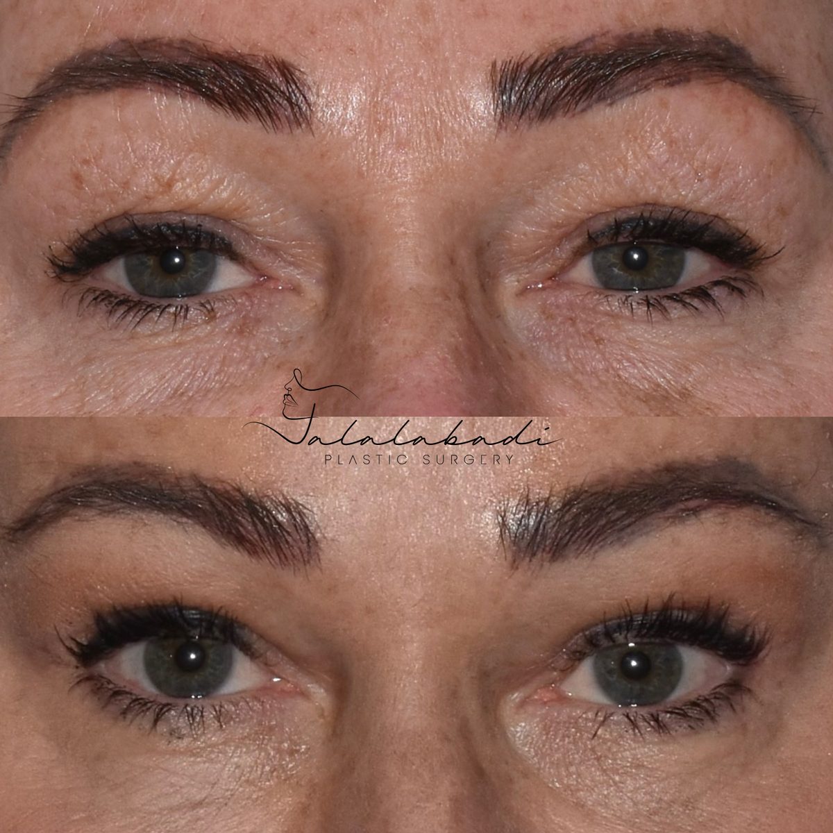 Beverly Hills Blepharoplasty Before and After