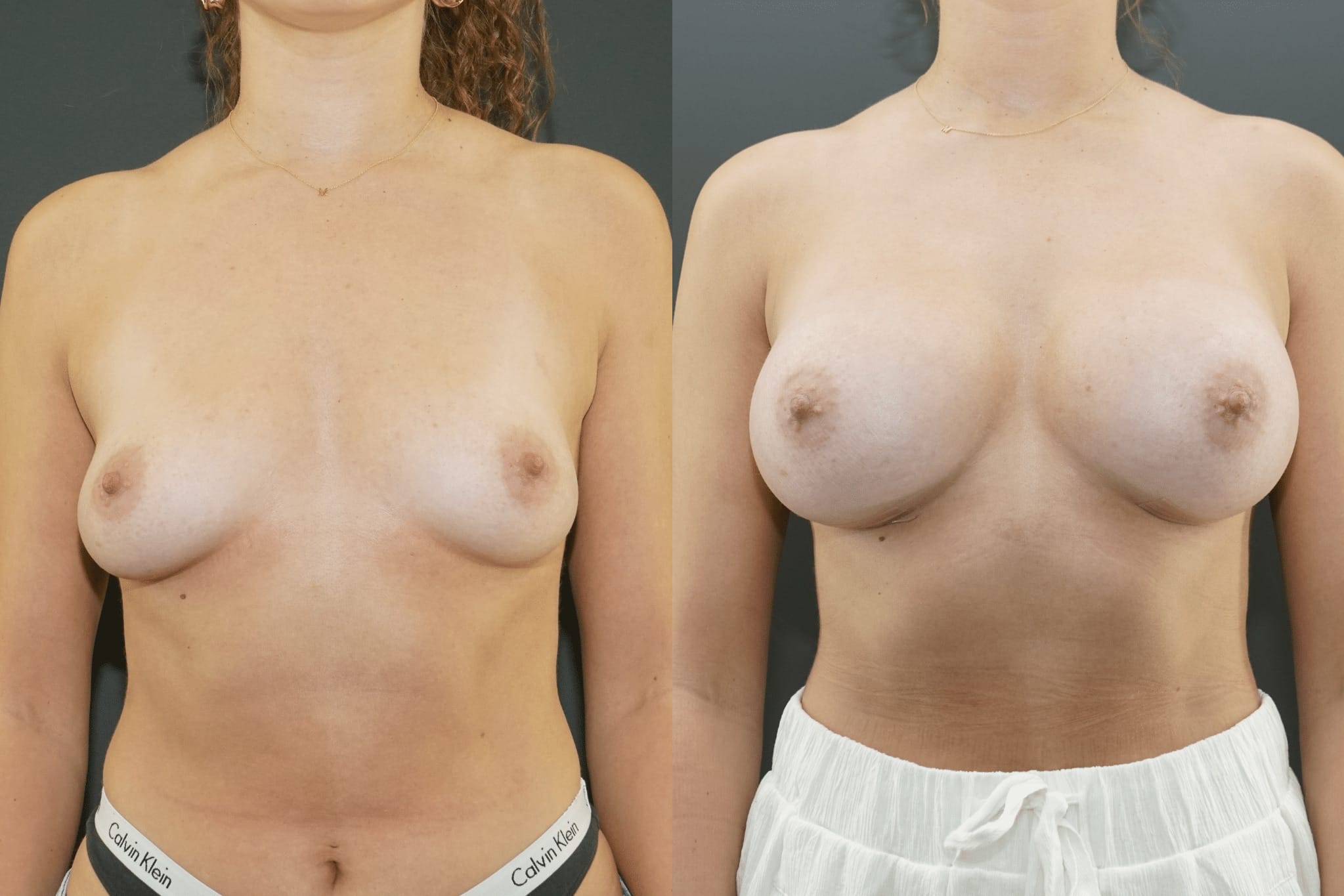 Breast Augmentation Beverly Hills