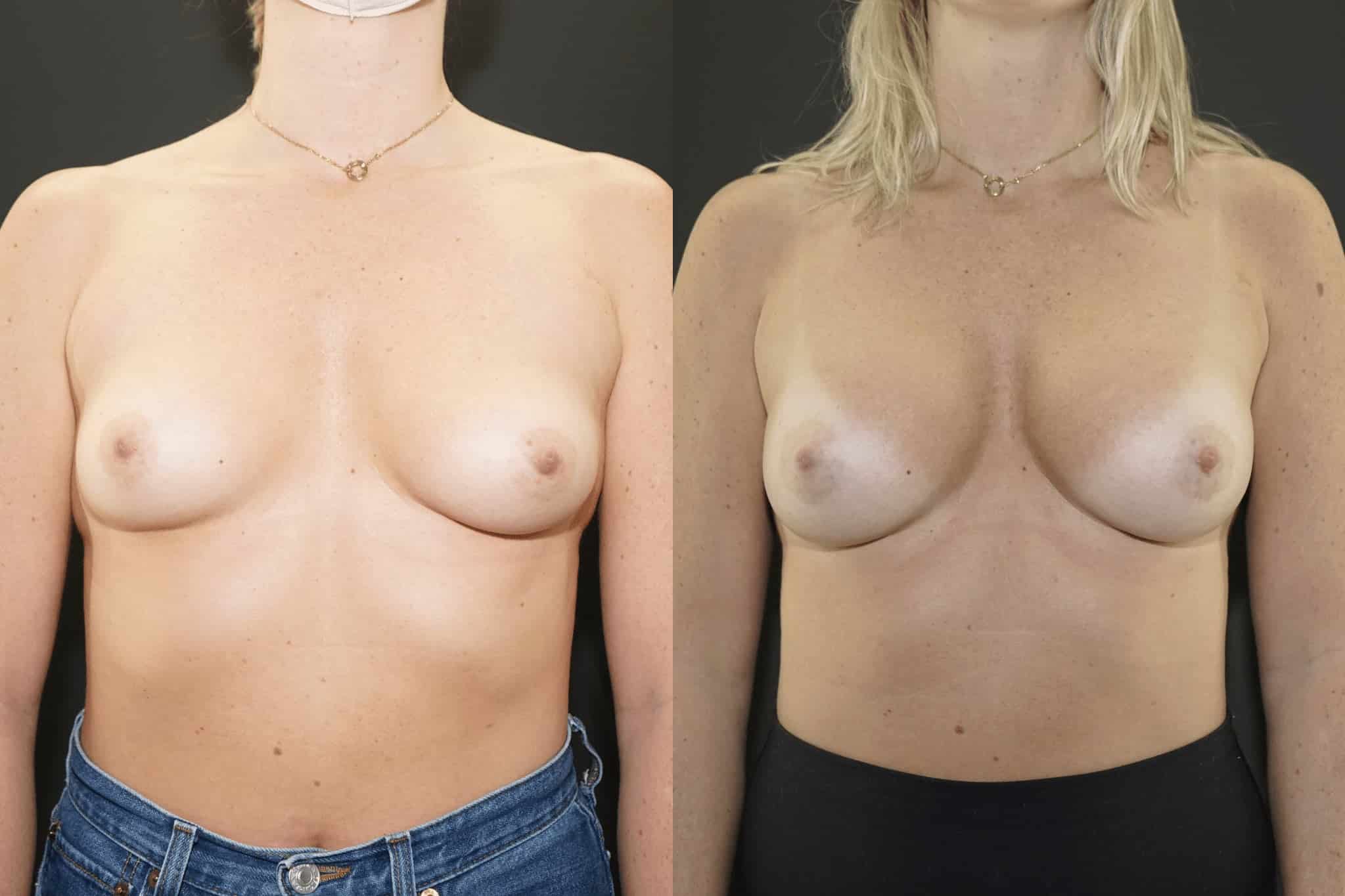 Beverly Hills Breast Implants