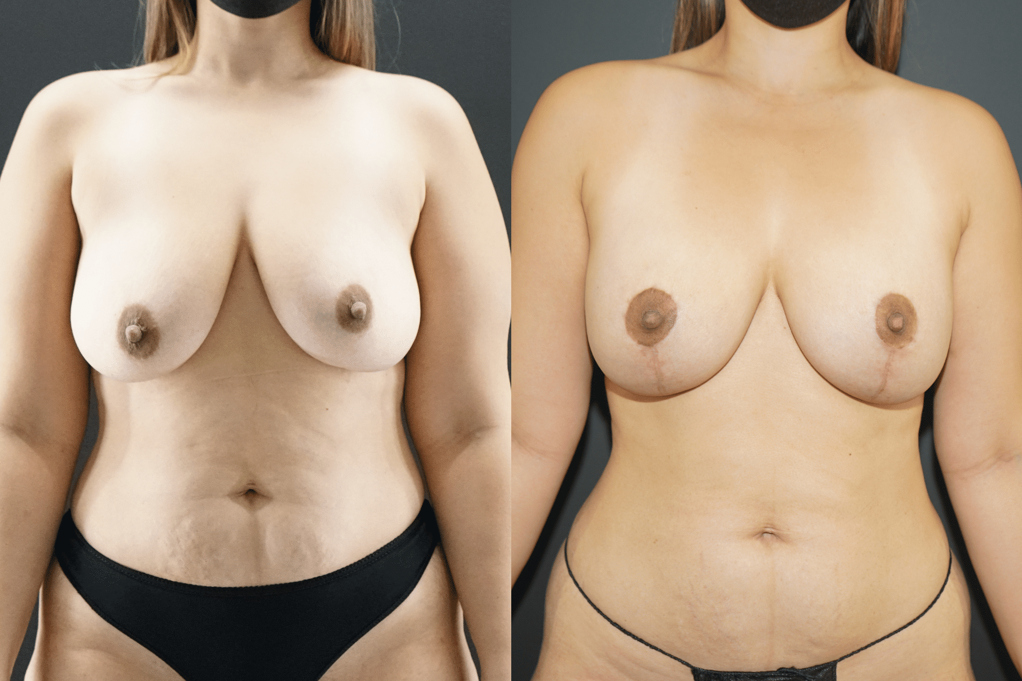 Beverly Hills Breast Lift