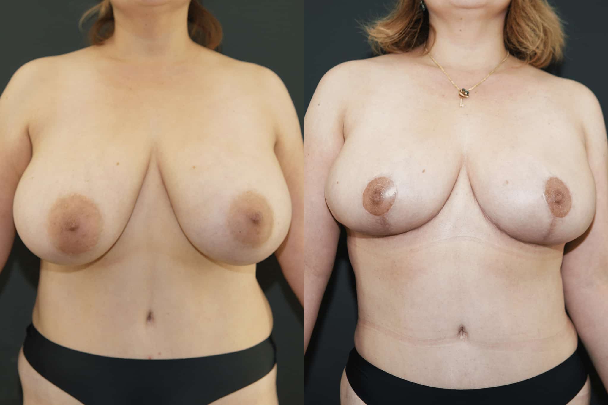Beverly Hills Breast Reduction